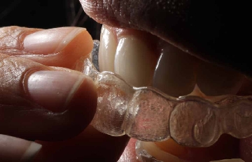 Invisalign Teeth Straightening